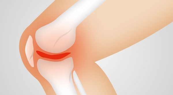 Arthrose: Die sanfte Therapie
